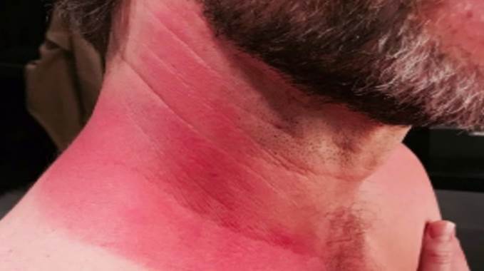 Avoid Sunburns with SPF30 Sunscreen Lotion